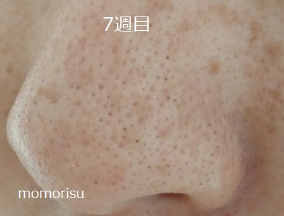 鼻の黒ずみ毛穴7週目の様子で透明感が増した画像