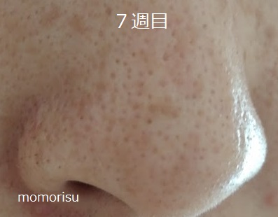 鼻の黒ずみ毛穴7週目の様子