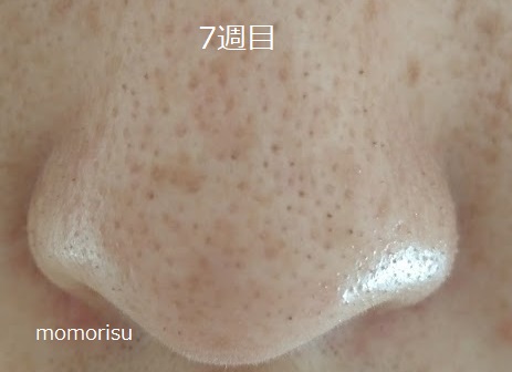 鼻の黒ずみ毛穴の様子7週目