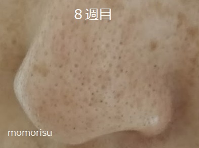 鼻の黒ずみ毛穴8週目の様子左向き