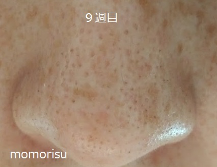 毛穴改善9週目の鼻正面の画像