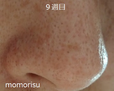 毛穴改善9週目 鼻の右向き画像