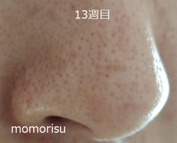毛穴ビフォーアフター13週目右向きの画像