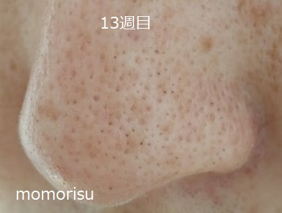 毛穴ビフォーアフター13週目 左向きの画像