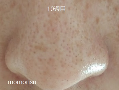 黒ずみ毛穴の画像10週目 正面
