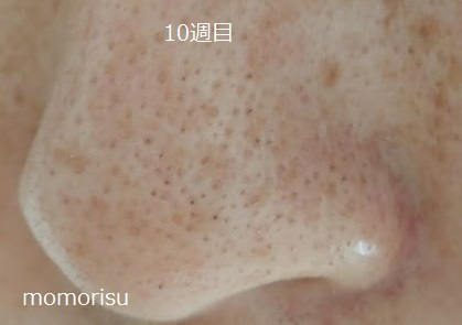 黒ずみ毛穴の画像10週目 左向き