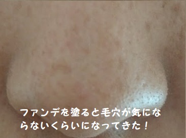 DUOクレンジングバームを使った120日後のファンデを塗った写真